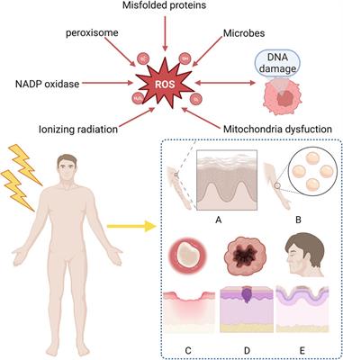 Radiation-induced skin reactions: oxidative damage mechanism and antioxidant protection